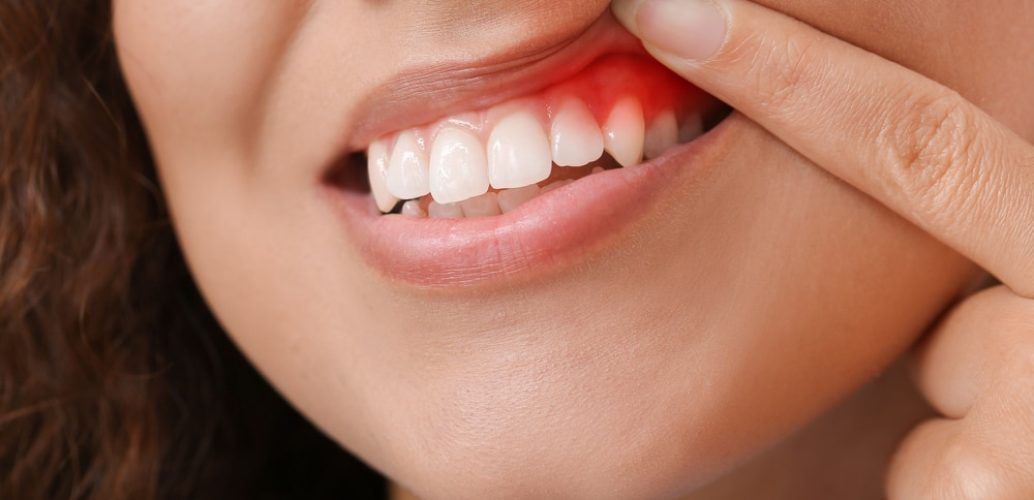 How To Avoid Gum Disease